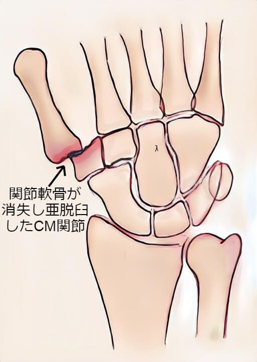 母指CM関節症（変形性関節症）の原因