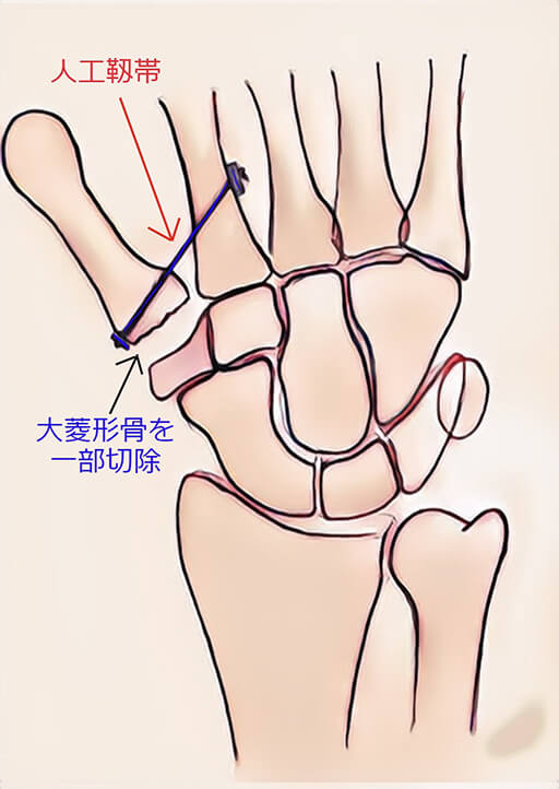 関節鏡視下関節形成術