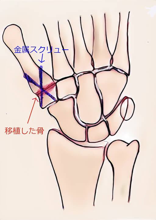 関節鏡視下関節固定術